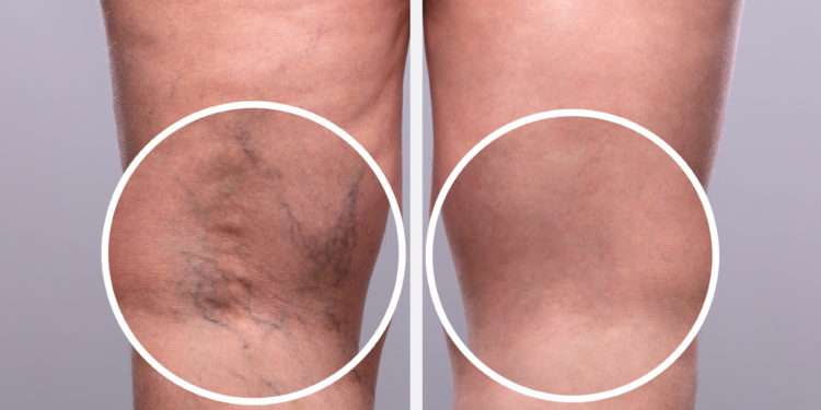 Dovolená bez studu – zatočte s nevzhlednými „křečáky“ ještě před létem